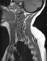 Astrocytoma - spinal cord (Radiopaedia 69769-79758 Sagittal T1 2).jpg