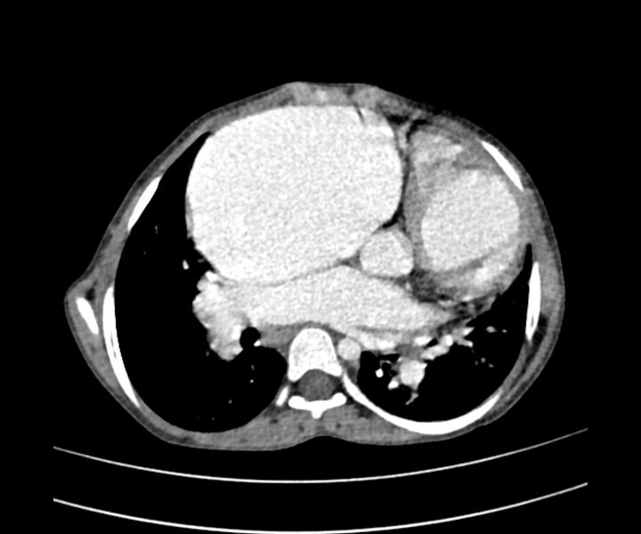 File:Atrial septal defect complicated by Eisenmenger syndrome (Radiopaedia 53707-59768 Axial C+ CTPA 17).jpg