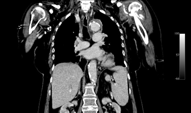 File:Atypical dissection of the thoracic aorta (Radiopaedia 10975-78320 B 22).jpg