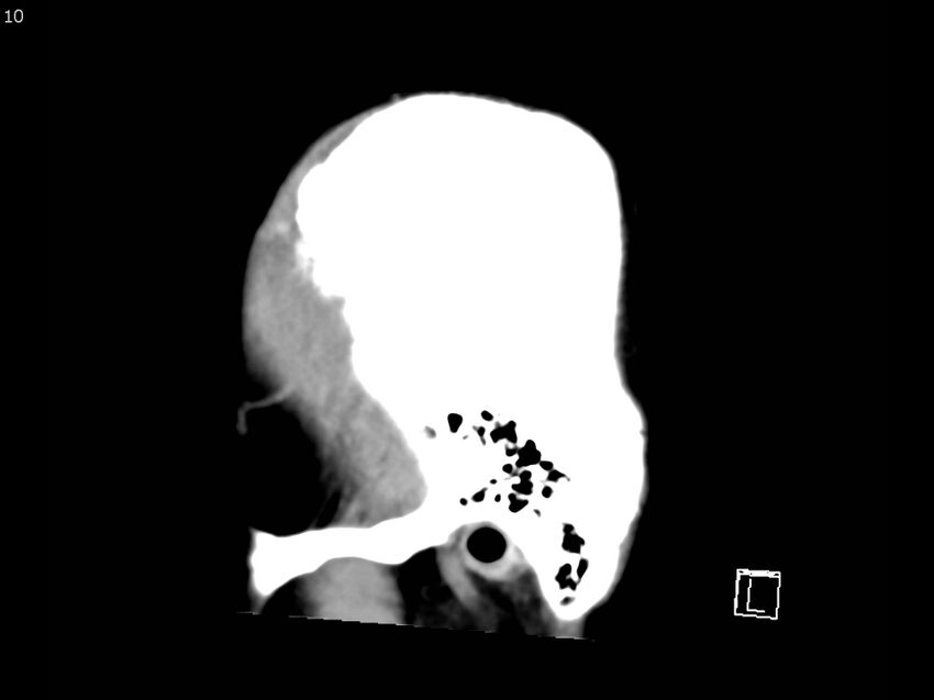 Atypical meningioma - intraosseous (Radiopaedia 64915-73867 C 8).jpg