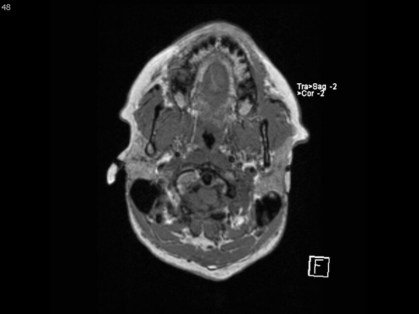 Atypical meningioma - intraosseous (Radiopaedia 64915-74572 Axial T1 48).jpg