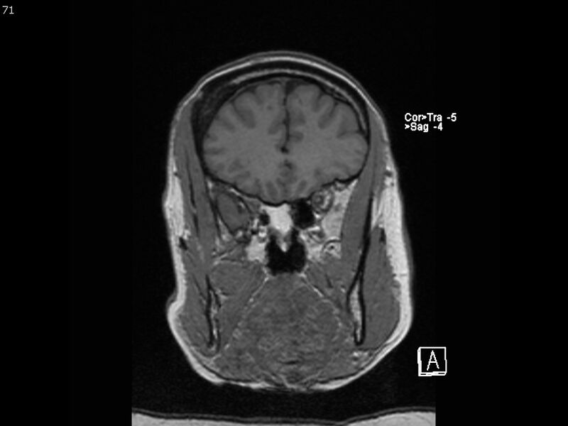 File:Atypical meningioma - intraosseous (Radiopaedia 64915-74572 Coronal T1 71).jpg