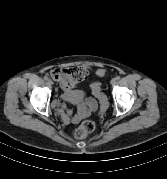 File:Autosomal dominant polycystic kidney disease (Radiopaedia 41918-44922 Axial non-contrast 33).jpg