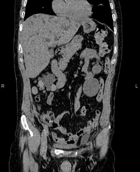 File:Autosomal dominant polycystic kidney disease (Radiopaedia 87830-104287 Coronal non-contrast 18).jpg