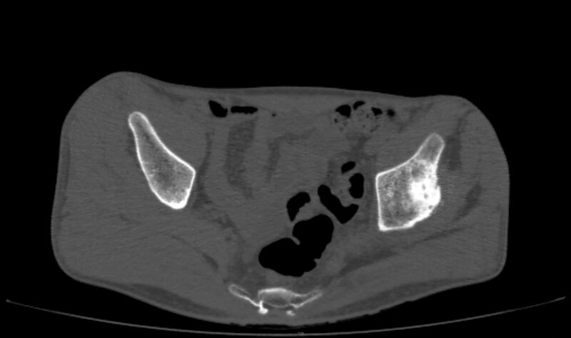 File:Avascular necrosis of the left hip (Radiopaedia 75068-86125 Axial bone window 11).jpg