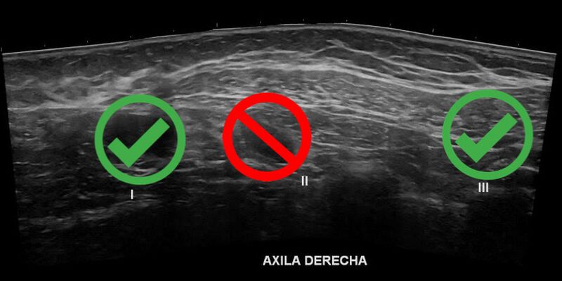 File:Axillary lymph nodes - surgical levels (Radiopaedia 84413-99751 B 1).JPEG
