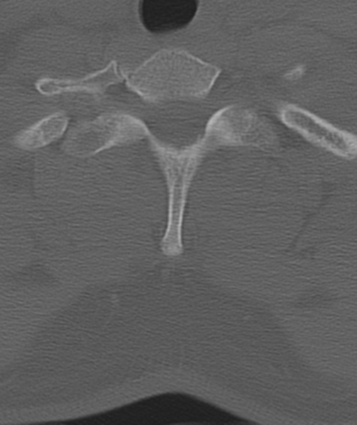 File:Axis peg fracture (type 3) and atlas lateral mass (type 4) fracture (Radiopaedia 37474-39324 Axial bone window 49).png