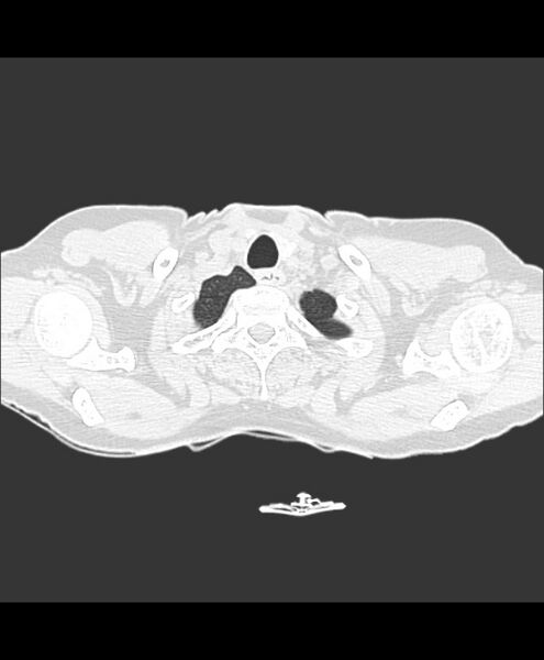 File:Azygos fissure and azygos lobe (Radiopaedia 41841-44832 Axial lung window 34).jpg