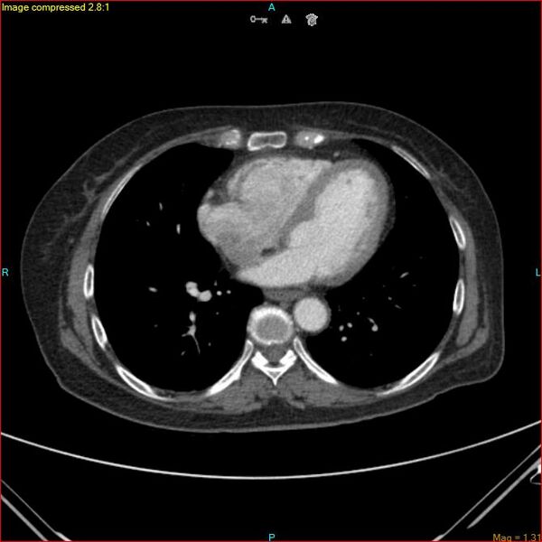 File:Azygos vein aneurysm (Radiopaedia 77824-90130 B 38).jpg