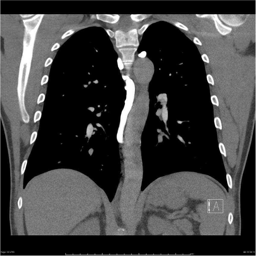 Azygos venous system anatomy (CT pulmonary angiography) (Radiopaedia 25928-26077 Coronal C+ CTPA 50).jpg