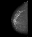 BIRADS V lesion (Radiopaedia 72355-82880 C 1).PNG