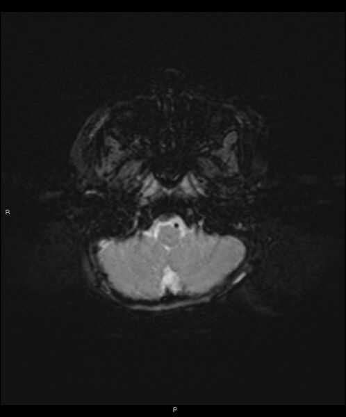 File:Basal ganglia and parenchymal ischemia (Radiopaedia 45818-50084 Axial SWI 5).jpg
