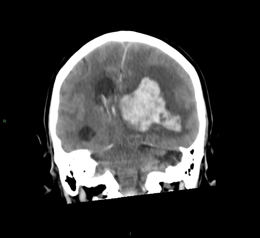 Basal ganglia hemorrhage (Radiopaedia 58775-66008 Coronal non-contrast 29).jpg