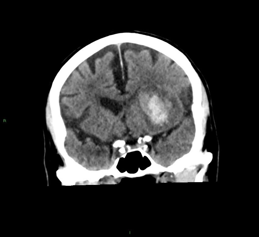 Basal ganglia hemorrhage (Radiopaedia 58791-66025 Coronal non-contrast 40).jpg
