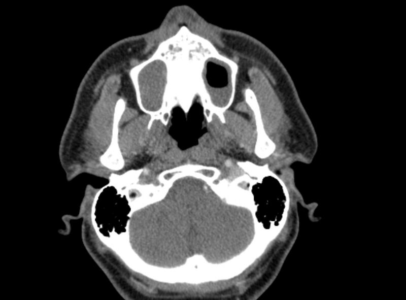 File:Benign mixed salivary tumor of the parotid gland (Radiopaedia 35261-36792 A 12).jpg