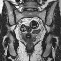Bicornuate uterus (Radiopaedia 11104-11492 Coronal T2 18).jpg