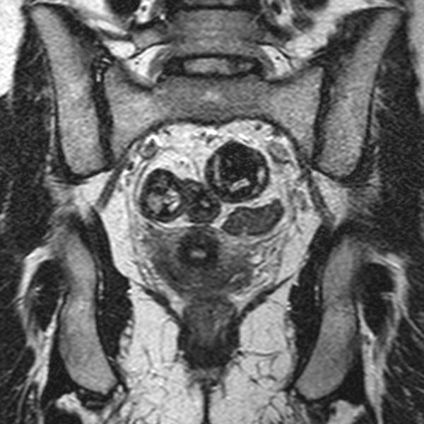 File:Bicornuate uterus (Radiopaedia 11104-11492 Coronal T2 18).jpg