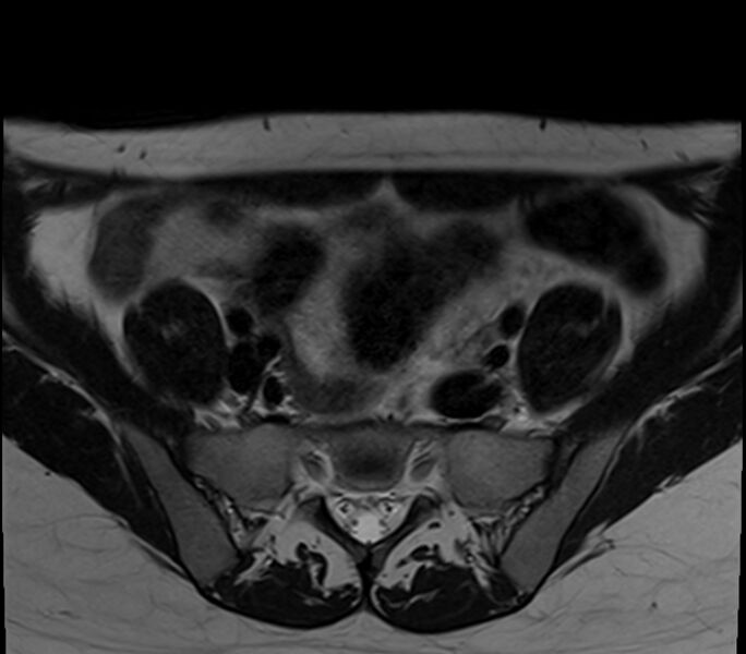 File:Bicornuate uterus (Radiopaedia 71214-81511 Axial T2 29).jpg