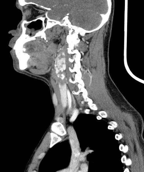 File:Bilateral carotid body tumors (Radiopaedia 52899-58827 C 16).jpg