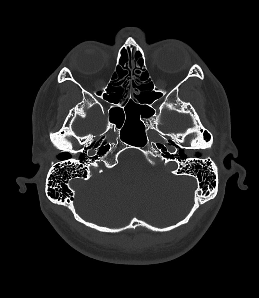 Bilateral medial canal fibrosis (Radiopaedia 85598-101344 Axial bone window 22).jpg