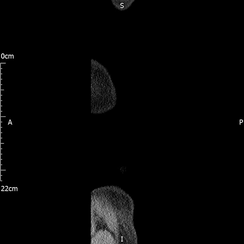 Bilateral medullary nephrocalcinosis with ureteric calculi (Radiopaedia 71269-81569 C 5).jpg