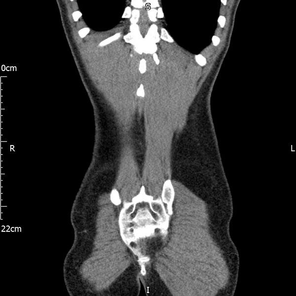 File:Bilateral medullary nephrocalcinosis with ureteric calculi (Radiopaedia 71269-81569 Coronal non-contrast 67).jpg