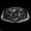 Bilateral ovarian fibroma (Radiopaedia 44568-48293 Axial T2 14).jpg