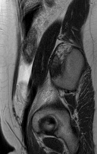 File:Bilateral ovarian fibrothecomas - adolescent (Radiopaedia 86604-102707 Sagittal T2 7).jpg