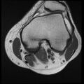 Bilateral popliteal artery entrapment (dynamic angiogram) (Radiopaedia 9420-10105 Axial PD 1).jpg