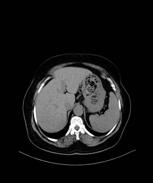 File:Bilateral sporadic synchronous clear cell renal cell carcinoma (Radiopaedia 85035-100572 Axial non-contrast 11).jpg