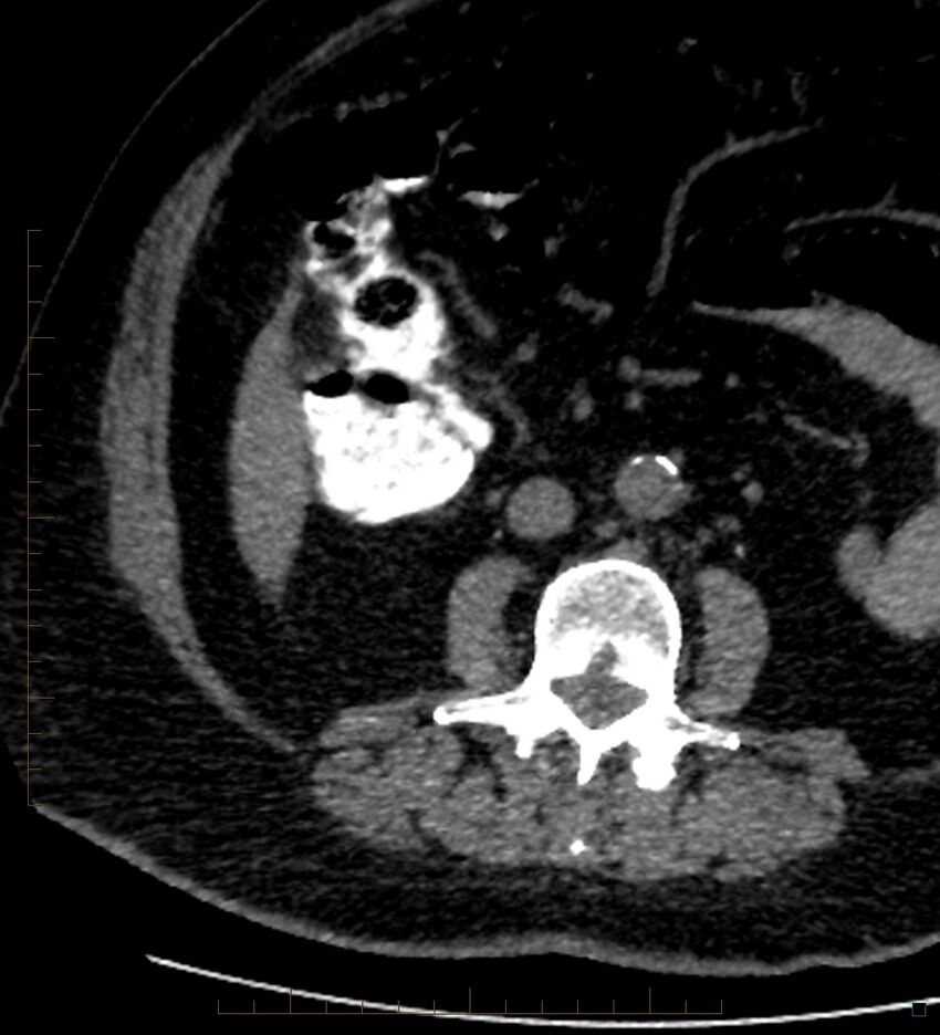 Bile leak from accessory duct(s) of Luschka post cholecystectomy (Radiopaedia 40736-43389 A 59).jpg