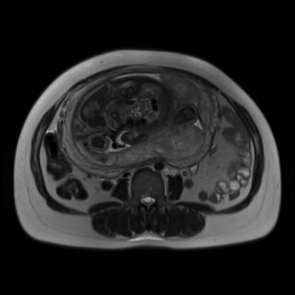 File:Bilobed placenta accreta (Radiopaedia 69648-79591 Axial T2 18).jpg