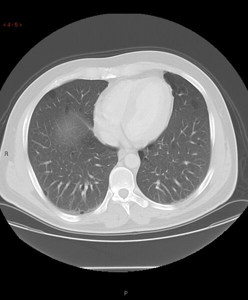 File:Birt-Hogg-Dubé syndrome (Radiopaedia 53814-60013 Axial lung window 5).jpg