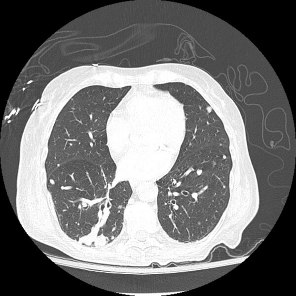 File:Bladder cancer metastases (Radiopaedia 9824-10409 Axial lung window 2).jpg