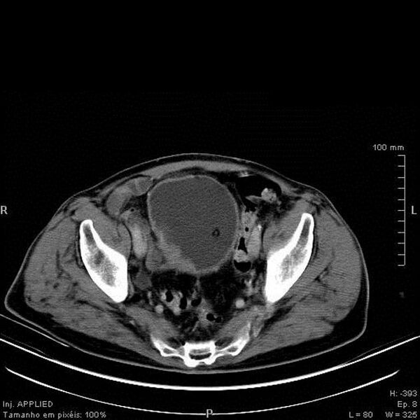 File:Bladder squamous cell carcinoma (Radiopaedia 14130-13984 B 6).jpg
