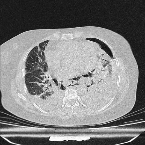 File:Boerhaave syndrome (Radiopaedia 45644-49799 Axial lung window 76).jpg