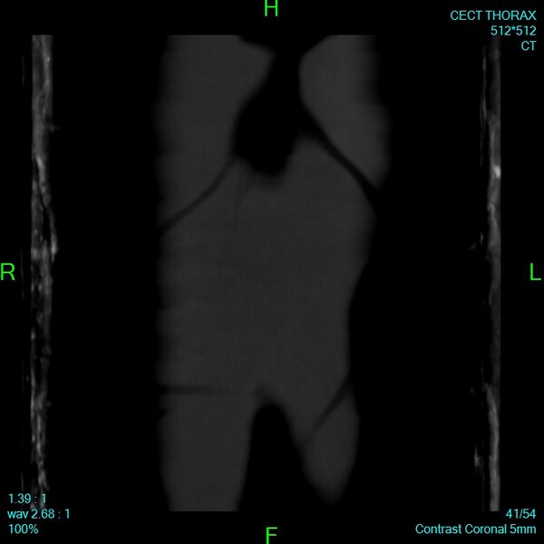 File:Bone metastases from lung carcinoma (Radiopaedia 54703-60937 Coronal bone window 41).jpg
