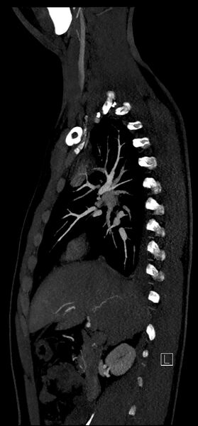 File:Brachiocephalic trunk pseudoaneurysm (Radiopaedia 70978-81191 C 36).jpg