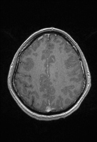 File:Brain abscess with ventriculitis (Radiopaedia 85703-101495 Axial T1 C+ 128).jpg