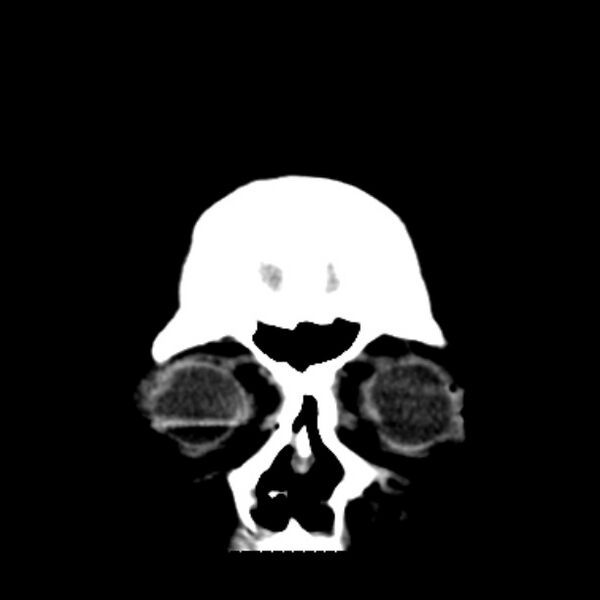 File:Brain cortical laminar necrosis (Radiopaedia 25822-25971 C 5).jpg