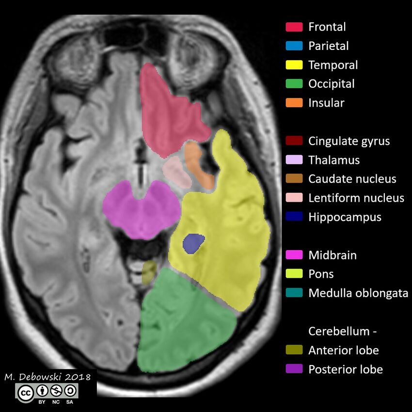 Brain lobes - annotated MRI (Radiopaedia 61691-69700 Axial 44).JPG