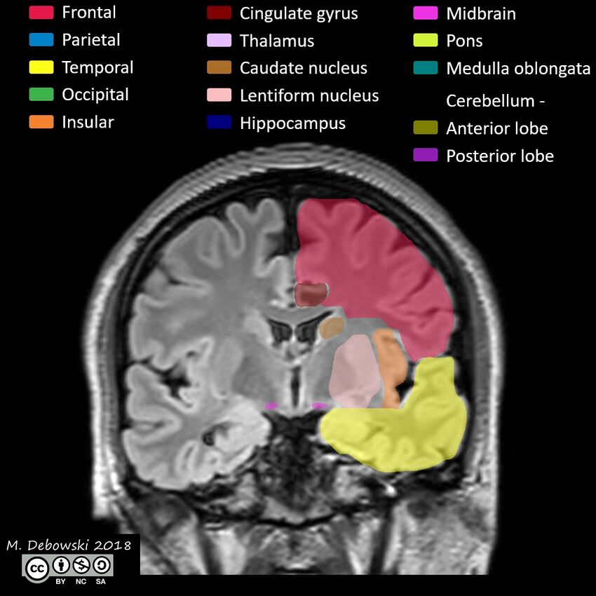 Brain lobes - annotated MRI (Radiopaedia 61691-69700 Coronal 32).JPG