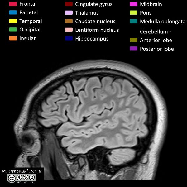 File:Brain lobes - annotated MRI (Radiopaedia 61691-69700 Sagittal 11).JPG