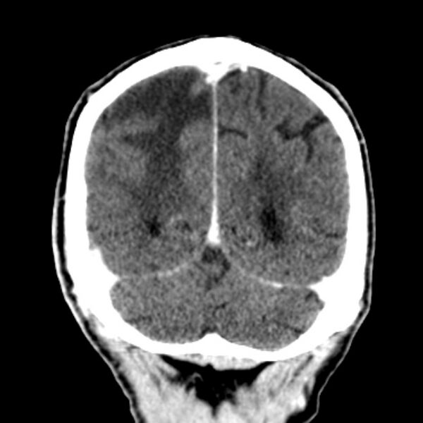 File:Brain metastases from lung cancer (Radiopaedia 27849-28092 Coronal C+ delayed 52).jpg