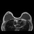 Breast implants - MRI (Radiopaedia 26864-27035 Axial T1 22).jpg