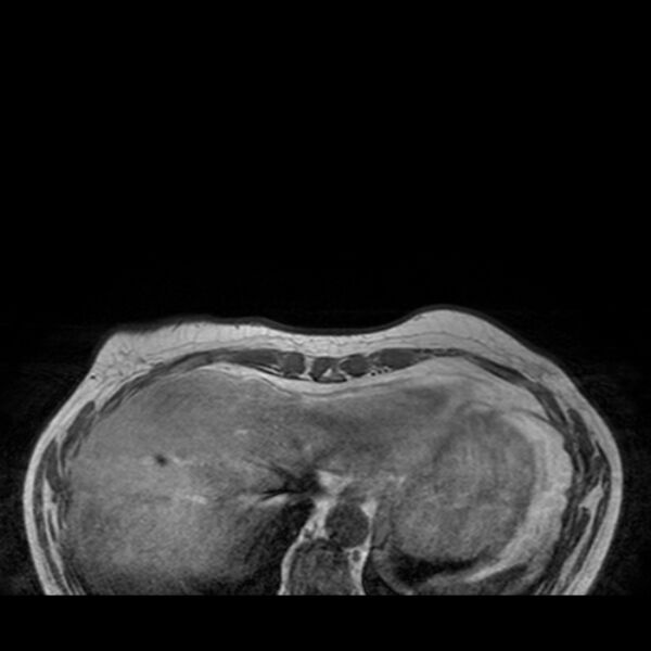 File:Breast implants - MRI (Radiopaedia 26864-27035 Axial T1 3).jpg
