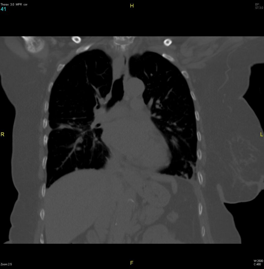 Breast primary with lung and bone metastases (Radiopaedia 40620-43228 bone window 41).jpg