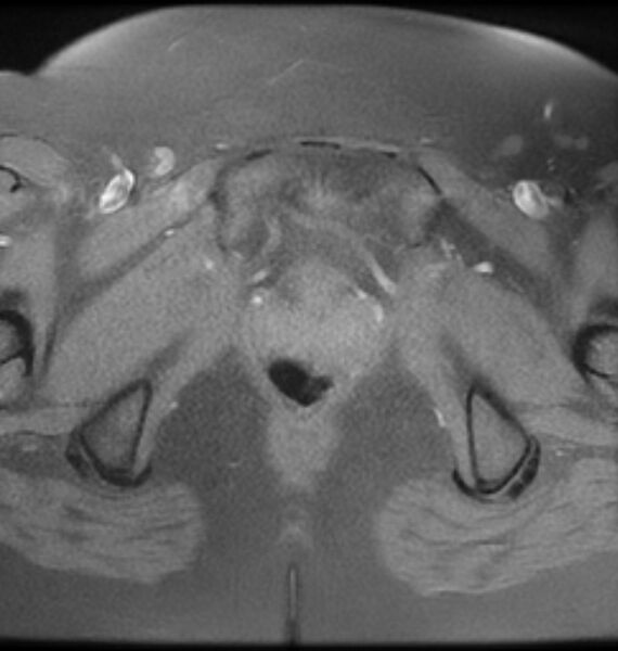 File:Broad ligament leiomyoma (Radiopaedia 81634-95516 Axial T1 fat sat 24).jpg