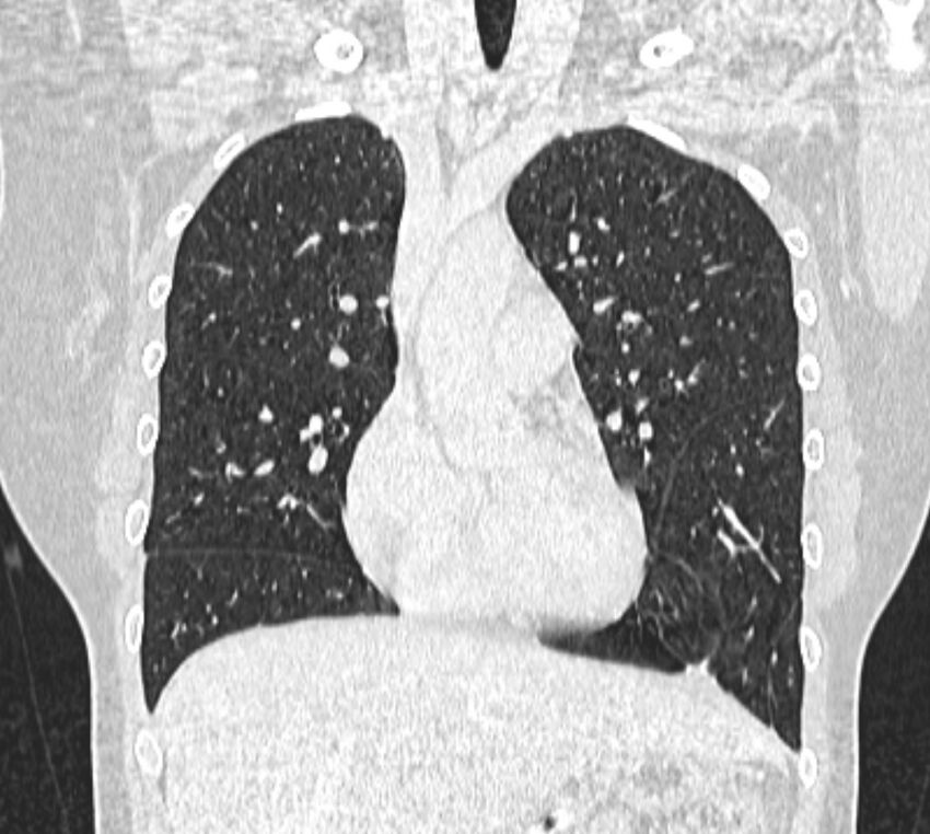 Bronchial atresia (Radiopaedia 50007-55297 Coronal lung window 36).jpg