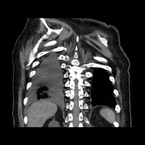 File:Bronchogenic adenocarcinoma and pulmonary embolism (Radiopaedia 9097-9806 C 44).jpg